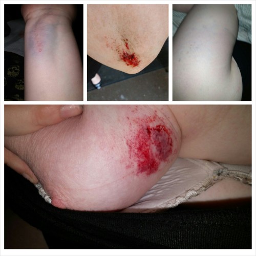 alice-is-wet:  I never use them, so I hope I’m doing this right, but putting trigger warnings on this just in case some of you are a little squeamish. :*  Howwwwever…  For those of you fascinated by gore like I am, check this out!  I had a nasty fall