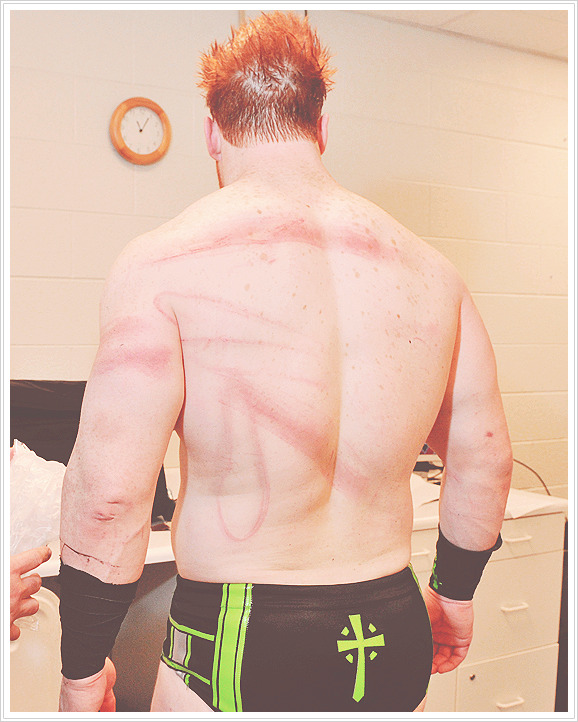 w4de-barrett:  Sheamus getting treated for his welts.  OUCH!!!