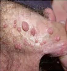 Genital herpes on penis