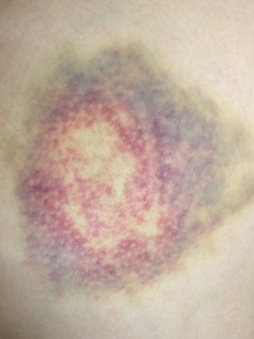 capricornfemme:xxtemple-of-starsxx:Suss their sick bruisesuss my sick bruise