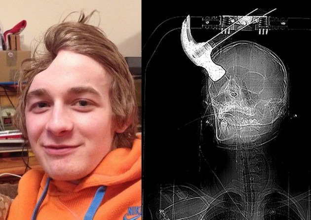 Teen survives an attack which left a hammer embedded in his brain  Connor Huntley