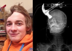 Teen survives an attack which left a hammer embedded in his brain