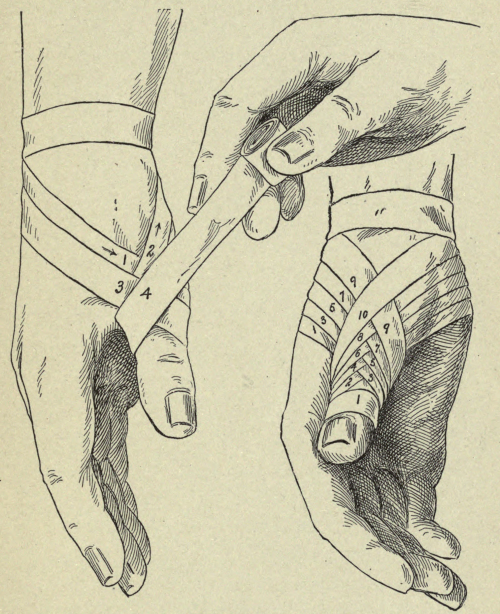 nemfrog:How to bandage the thumb. Practical bandaging. c.1914.Internet Archive