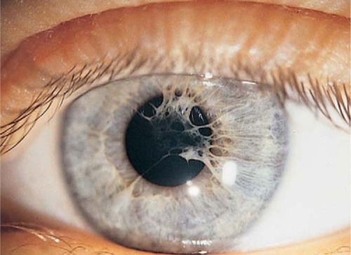 sixpenceee:  Persistent pupillary membranes are strands of tissue in the eye. They are remnants of blood vessels which supplied nutrients to the developing lens of the eye before birth. Normally these strands are gone by 4 or 5 weeks of age. PPM can