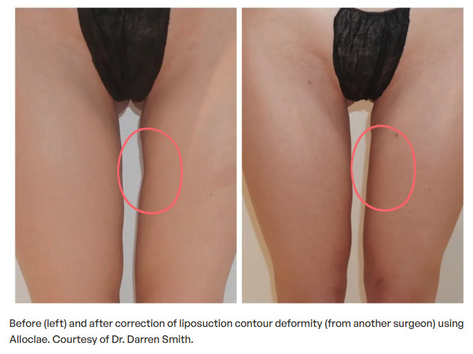 Alloclae Fat Transfer: Non-Surgical Donor Fat for Body Contouring