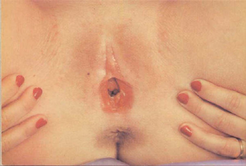 pussymodsgaloreA photo set of pussy mods with one thing in common, all have had their clit heads (glans) and inner labia removed. Particularly good examples of infibulation are the third and fourth ones down, where the outer labia have been cut or abraded