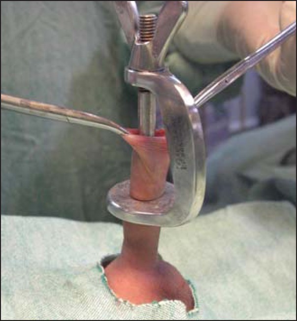 studsnpuds:  Circumcision using a Winkelmann Clamp. They’re made in adult sizes
