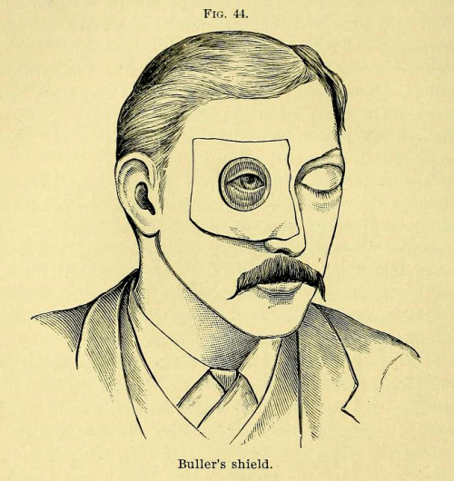 Dr. Buller’s shield, for use as protection on the unafflicted eye from germ spread while the o