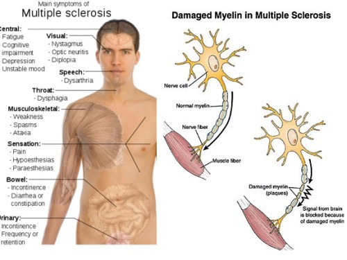 scienceyoucanlove: What causes multiple sclerosis? While the cause (etiology) of MS is still n