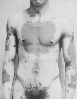 ohthentic:  abnormals:  maggotfaggot:From the book ”Photographic atlas of the diseases of the skin“ by George Henry Fox photographed by O. G. Mason  beauty in dis-ease  Oh