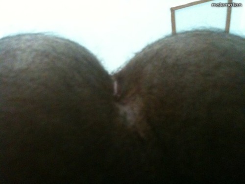 circumcision scar