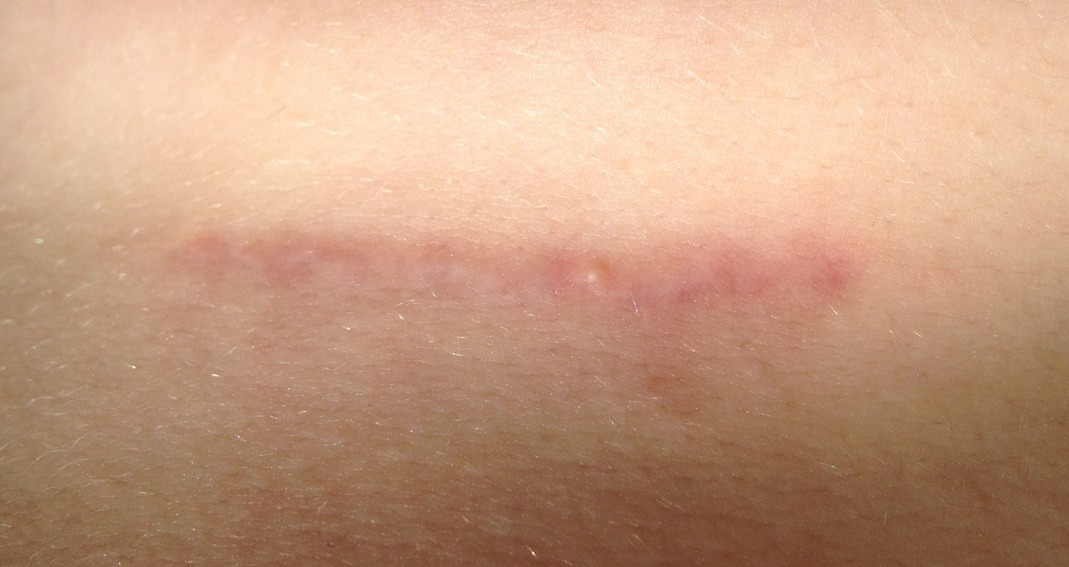 tieme-takeme:  4 Months Post-Op  Sooooo, they look really similar to last update