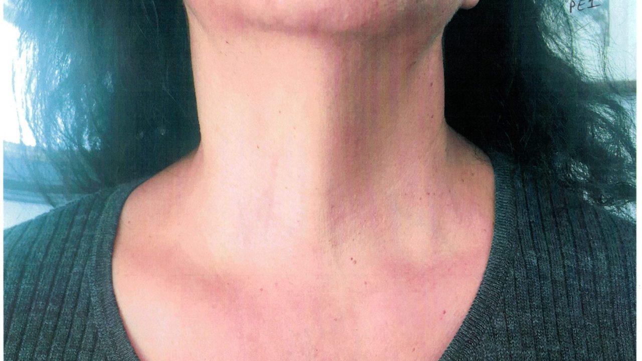 Thyroid Nodule — Should A 4 Cm Thyroid Nodule Be Removed