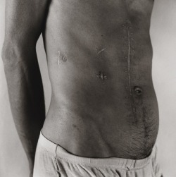 kradhe: Pascal: Scarred Abdomen,   1980. By Peter Hujar 