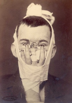 welcometothe1jungle:  Rhinoplasty: Loss of nose due to an injury and replacement by a finger in 1880.  