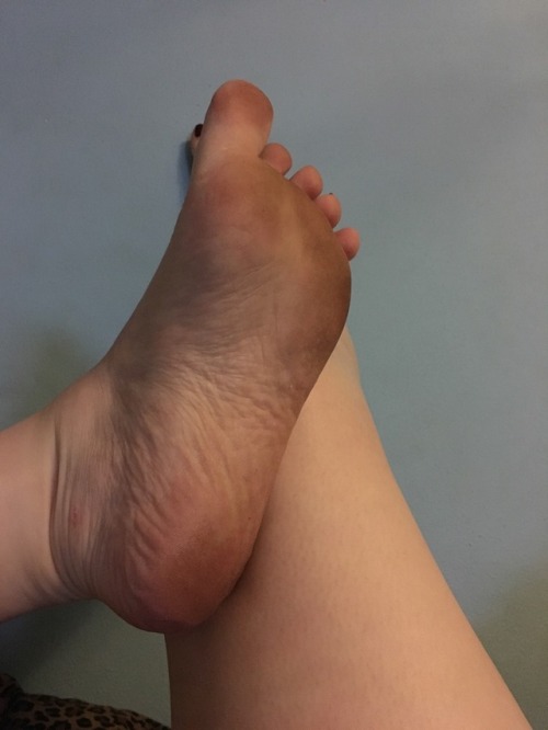 fuckyeahperfectfeet: Pitfalls of summer and that barefoot life