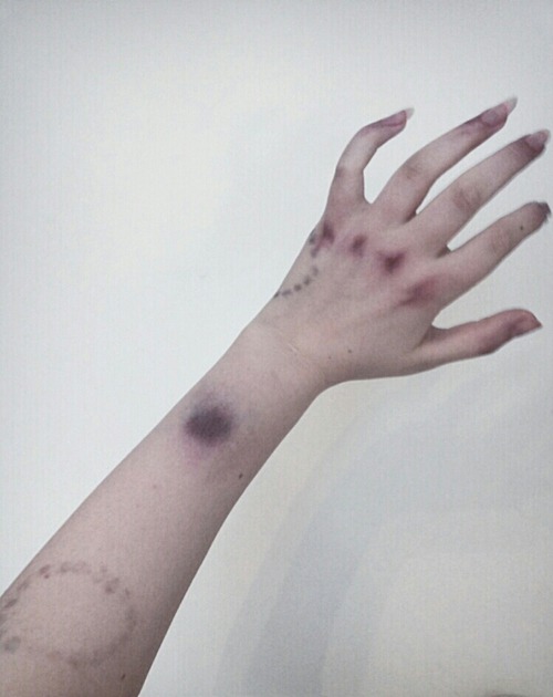 subdermal-hematoma:  -