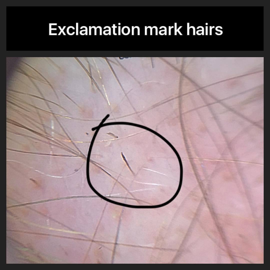 Blog of a Hair Loss Physician — “Exclamation mark hairs” are tiny 4 mm hairs  that...