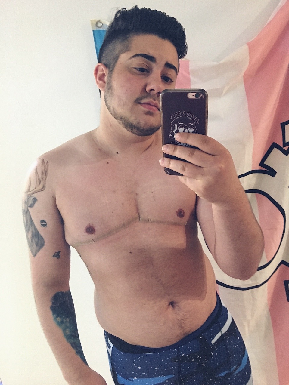 transbutts: 2015 pre t and pre op -&gt; 2018 2 years on t and 1 month post op