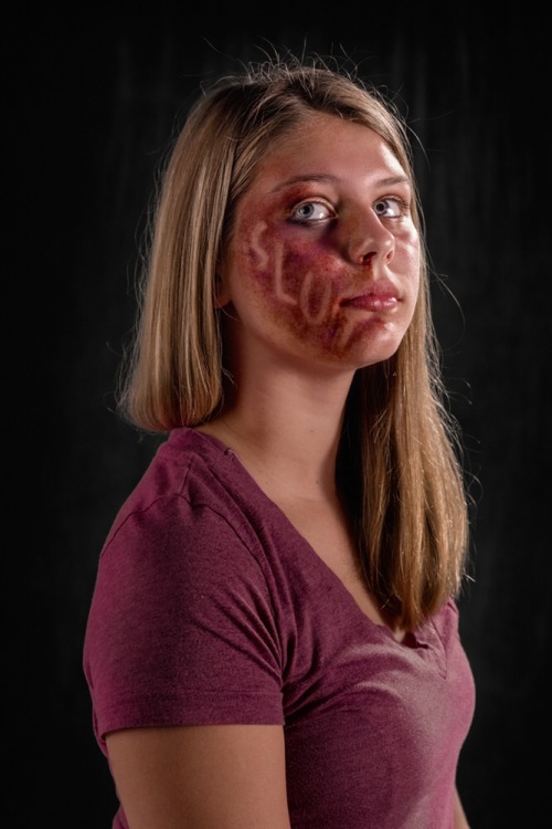 girl-in-nike: tonytobar: What if verbal abuse left the same scars as physical abuse? Would it be tak