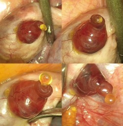 Human egg emerging from the ovary