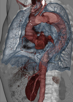 staceythinx:  Volume Rendering CT Scans by