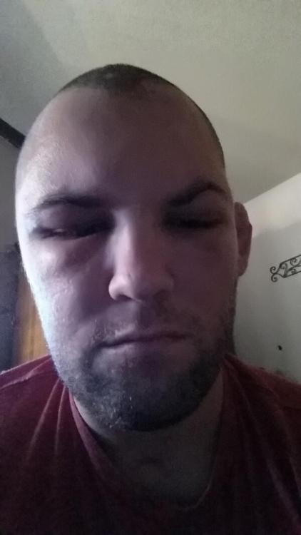 The UFC’s Matt Grice had his skull reattached and continues to recover from the injuries he su