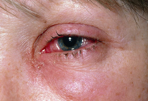 XXX eye irritation caused by viral conjunctivitis photo