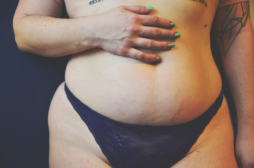 how to hide stretch marks in a few easy steps!