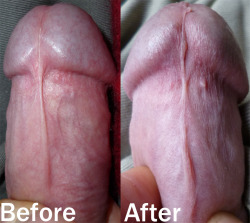 Gayguyinkc:  Nunchuks3:  Before An After My Frenular Tie: An Operation That I Performed