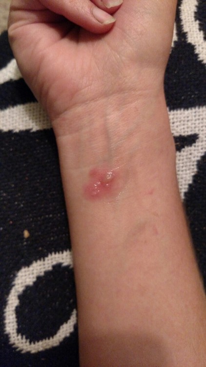 misadventured-piteous-overthrows:So sorry… Here’s my blister/blisters. It’s shiny because I just acc