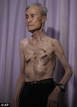 sixpenceee:  Atomic Bomb Survivor: Sumitery Taniguchi The frail 86-year-old body of Sumitery Taniguchi is a web of scars, that have criss-crossed his skin for 70 years. The elderly man was one of the many tens of thousands of victims of the atomic blast