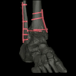 sixpenceee:  A foot reinforced with screws.Source: