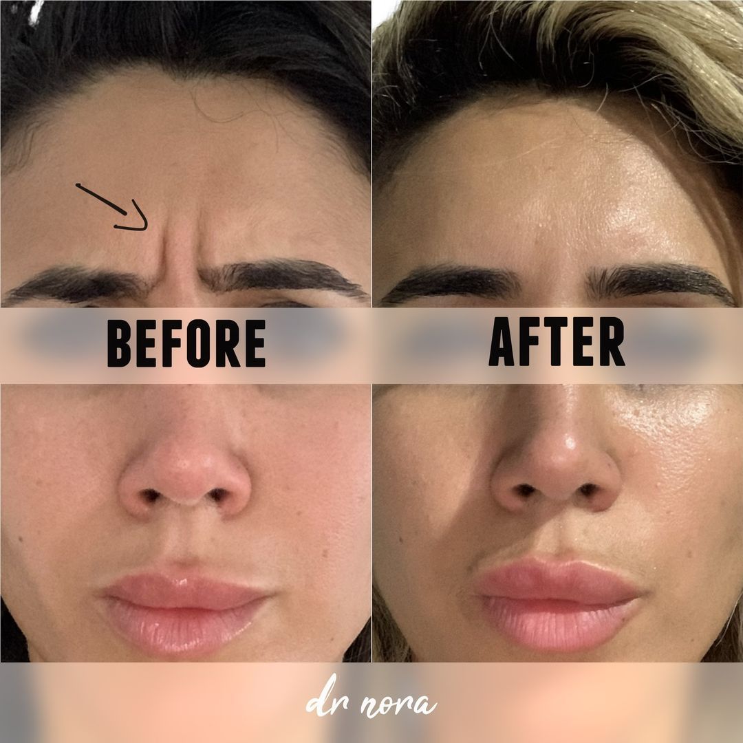 Anti-wrinkle treatment of the frown 😲Anti-wrinkle therapy is a way to reduce the appearance of strong and deep lines. Treatment time is 15 minutes, optimal results are seen at 2 weeks and lasts up to 3-5 months.
If you have any questions or would...