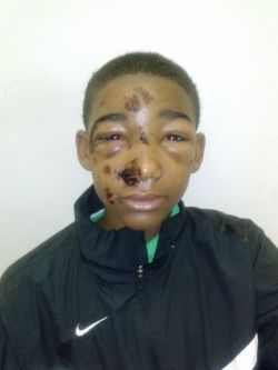 ourmbs:  thatweirdgirrl:  queennubian:  tw: police brutality missjia:  via Marissa Sargeant on Facebook: This is my 14 yr old son who was brutually tortured By 2 Tully town officers he was handcuff but they say he resisted arrest that yall tazzed him