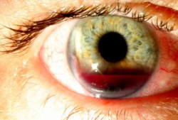 sixpenceee:  A hyphema is a collection of blood inside the front part of the eye. The blood may cover part or all of the iris and the pupil, and may partly or totally block vision in that eye. Hyphema is usually caused by trauma to the eye, though other