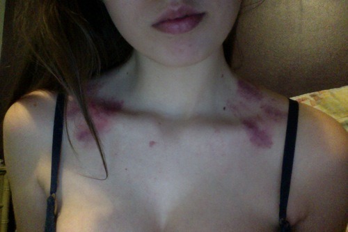 the-naughtyanon:  I need me some sex bruises.