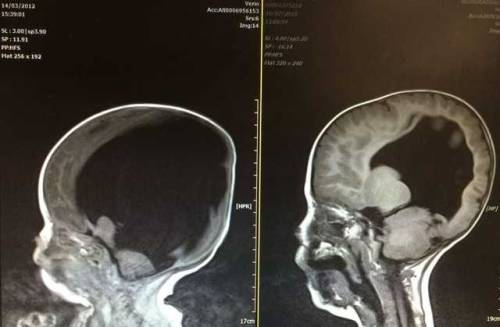 allthingsneuro:The Boy Who Grew a BrainNoah Wall was born with only 2% of a brain (left), spina bifi