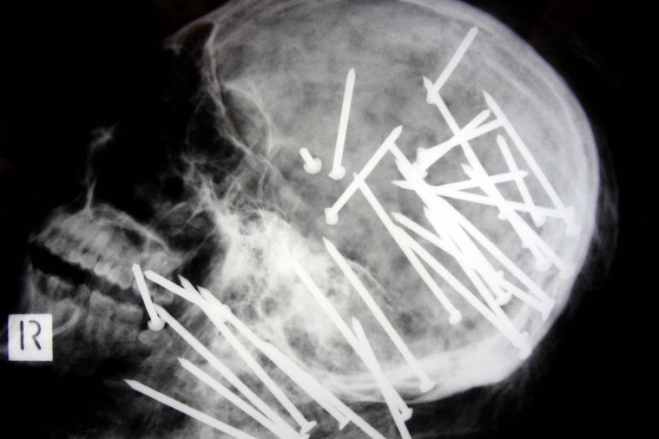 luciferlaughs:
“The post-mortem X-ray of 27-year-old Anthony Liu, who was shot repeatedly in the head with a high-powered nail gun. In total, his skull and neck were filled with 34 nails. His badly-decomposed body was discovered by two children in a...