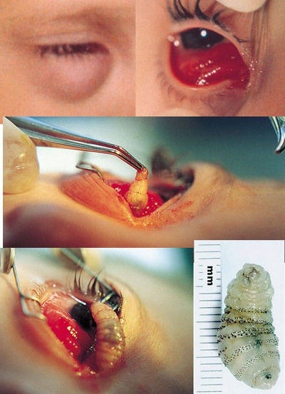 “WORM” removed from woman’s eye. “Anterior Orbital Myiasis caused by Human Botfly,” published in the July 2000 number of the Archives of Ophthalmology, a journal of the American Medical Association.