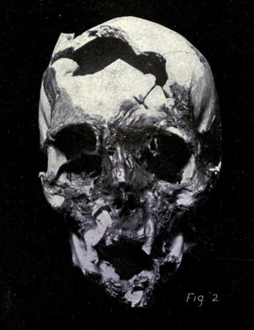 biomedicalephemera:  Fig 2: Gunshot Fracture of Lower Jaw and Cranium An American Text-Book of Surge