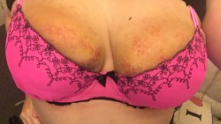 mysubdiary:  Bruise update.  Beautiful boobs. With and without