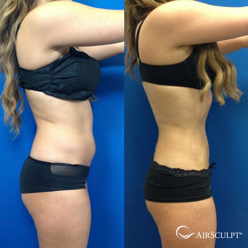 AirSculpt® Before & After - Elite Body Sculpture