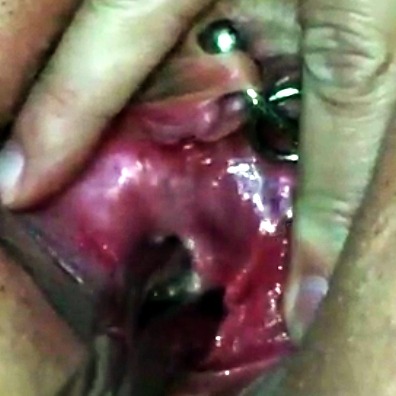 pussymodsgaloreSounding and stretching her peehole. She inserts one then two urethral sounds, though not very far. Remember, never force a sound in, and this is particularly important for the thinner sharper sounds that you may need to begin with, they