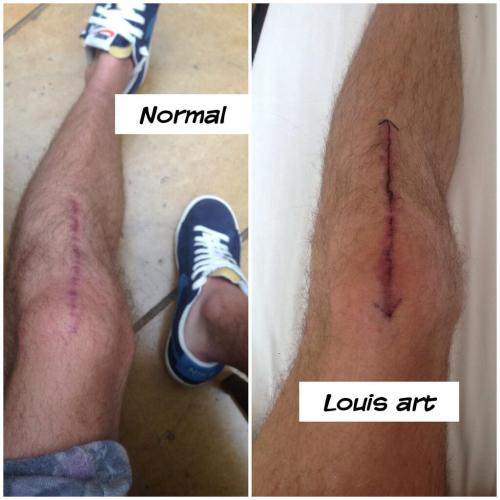 inconvenientbastards:   ‏@NiallOfficial: Haha @louis_tomlinson decided he was gona colour in my scar ! Looks mad   