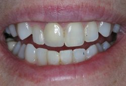 Dentures of any kind are meant to do more than just cosmetically replace missing teeth, and that is 