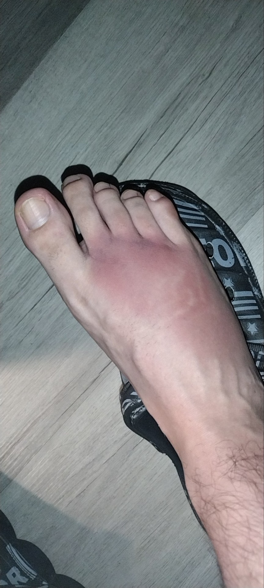 Think I Might Have Broken My Foot