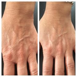 The carbon laser treatments are not just for faces this is before and after one treatment I done today on hands huge difference from just 1! Follow @laseredbeauty for more pics! Contact me for bookings by charleyatwell