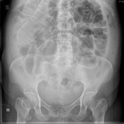 radiopaedia:  What is the diagnosis?  ANSWER: