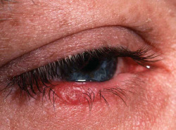 liltreebitch:  Types of Rosacea: Eye Irritation by RosaceaFacts.com on Flickr. 